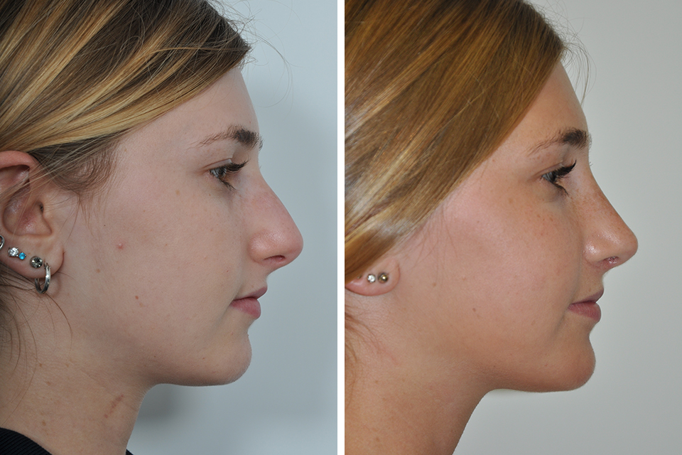 Rhinoplasty case #4098