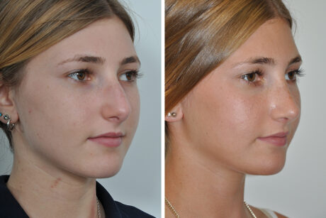 Rhinoplasty case #4098
