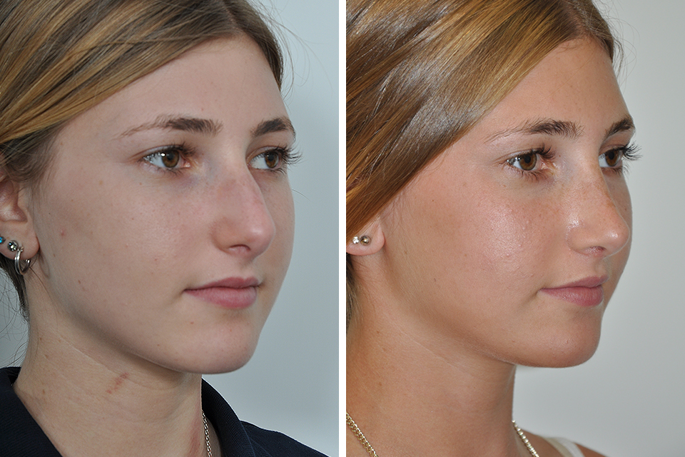 Rhinoplasty case #4098