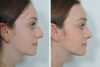 Rhinoplasty case #4274 slider thumbnail