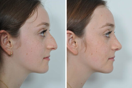 Rhinoplasty case #4274