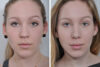 Rhinoplasty case #4282 slider thumbnail