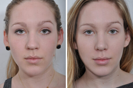 Rhinoplasty case #4282