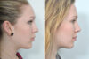 Rhinoplasty case #4282 slider thumbnail