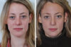 Rhinoplasty case #4268 slider thumbnail