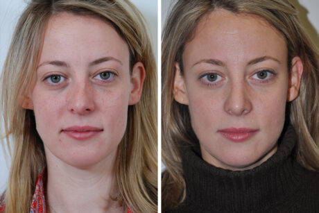 Rhinoplasty case #4268
