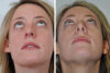 Rhinoplasty case #4268 slider thumbnail