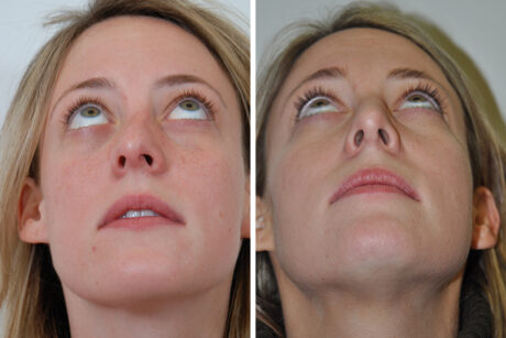Rhinoplasty case #4268