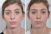 Rhinoplasty case #4169 slider thumbnail