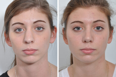 Rhinoplasty case #4169