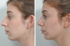 Rhinoplasty case #4169 slider thumbnail