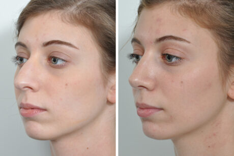 Rhinoplasty case #4169
