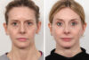 Rhinoplasty case #3998 slider thumbnail