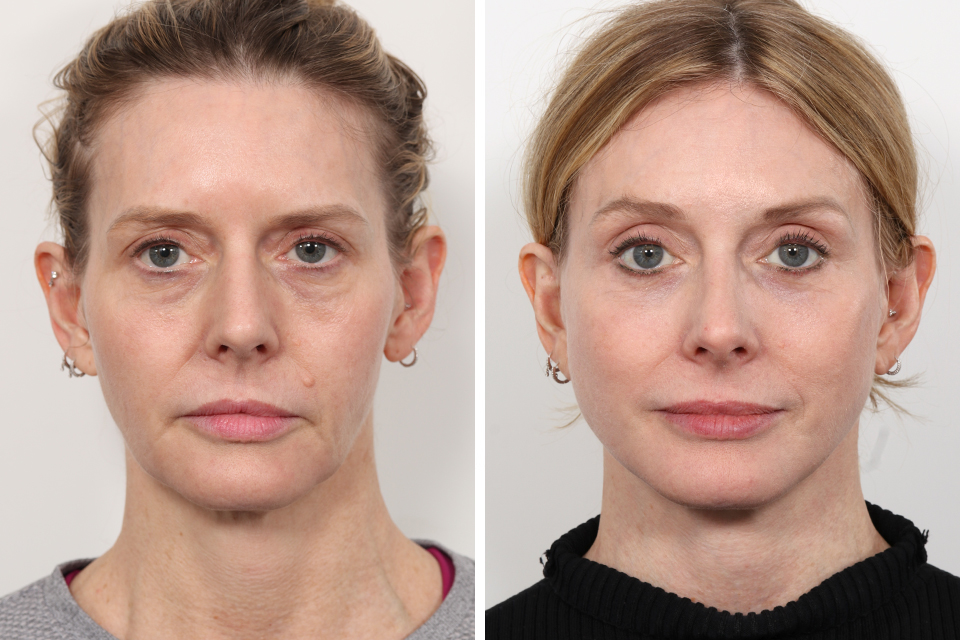 Rhinoplasty case #3998