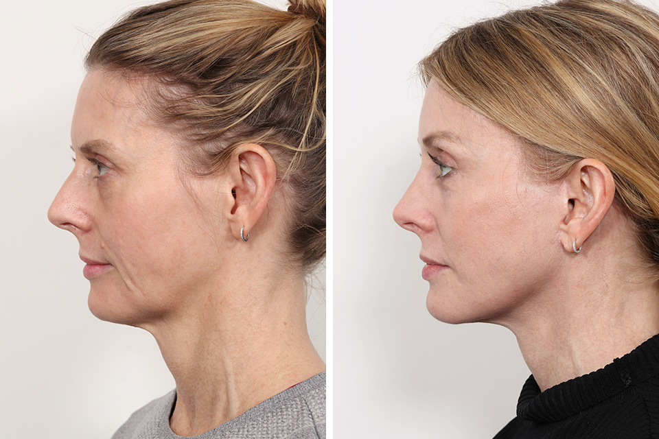 Rhinoplasty case #3998