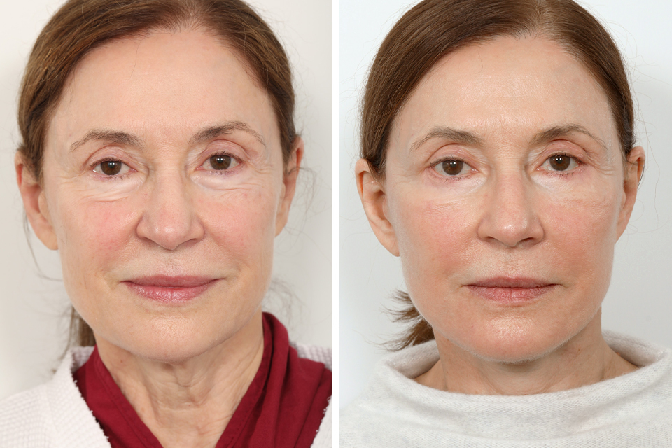 Blepharoplasty case #3609