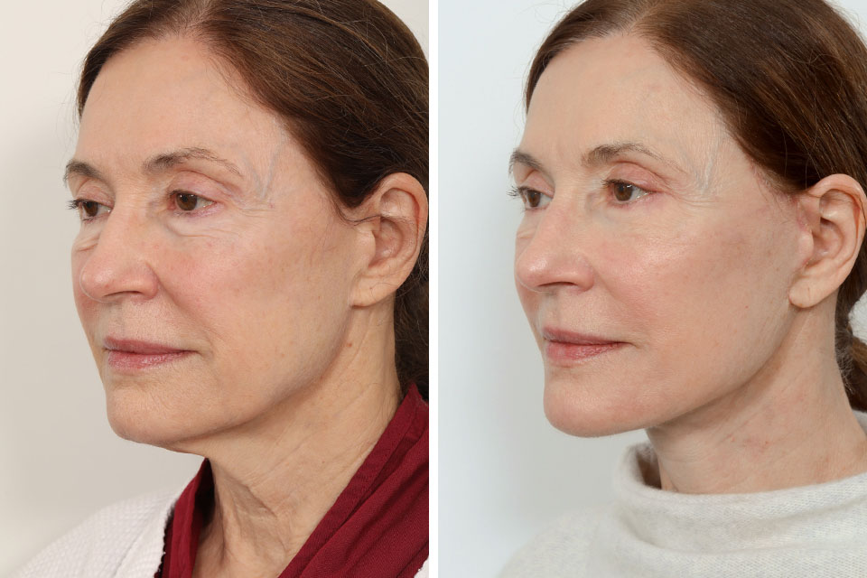 Blepharoplasty case #3609
