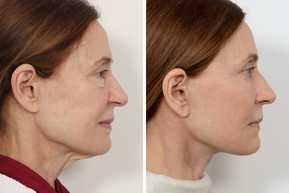 Blepharoplasty case #3609