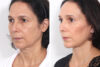 Blepharoplasty case #3584 slider thumbnail
