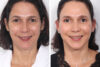 Blepharoplasty case #3584 slider thumbnail