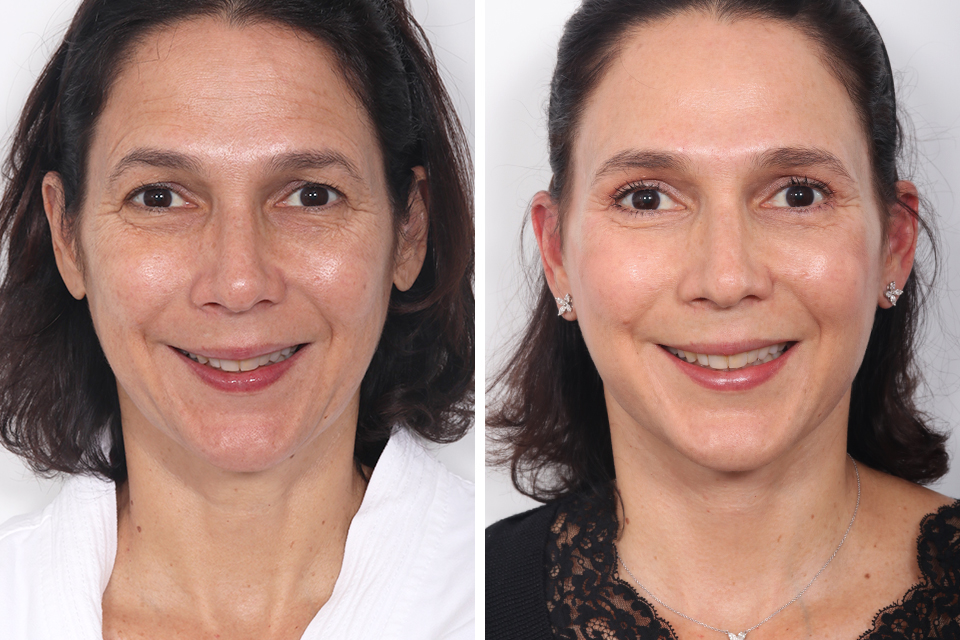 Blepharoplasty case #3584