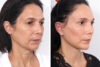 Blepharoplasty case #3584 slider thumbnail