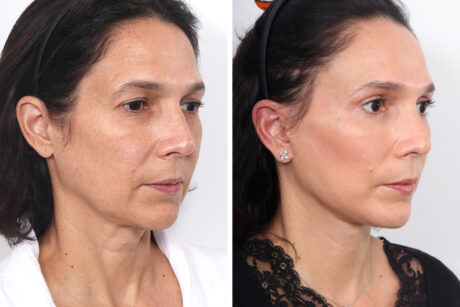 Blepharoplasty case #3584