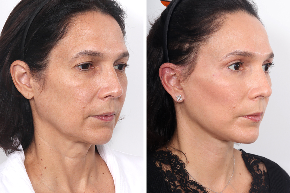 Blepharoplasty case #3584