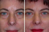 Blepharoplasty case #3621 slider thumbnail