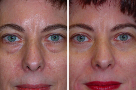 Blepharoplasty case #3621