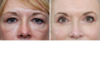 Blepharoplasty case #3606 slider thumbnail
