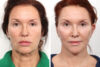 Blepharoplasty case #3563 slider thumbnail