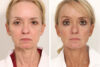 Blepharoplasty case #3555 slider thumbnail