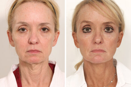 Blepharoplasty case #3555