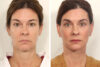 Blepharoplasty case #3559 slider thumbnail