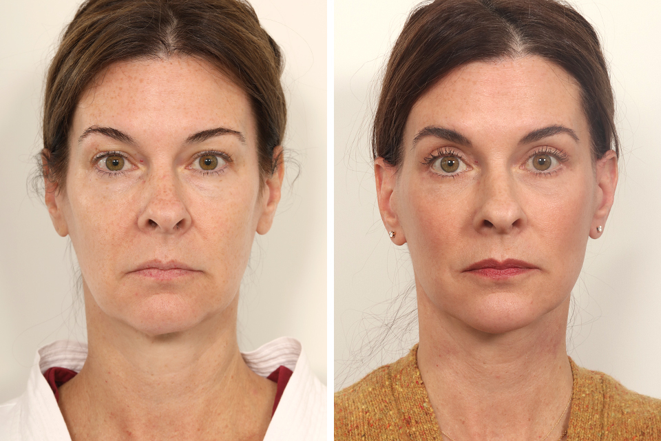 Blepharoplasty case #3559