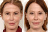 Blepharoplasty case #3540 slider thumbnail
