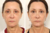 Blepharoplasty case #3578 slider thumbnail