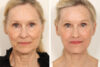 Blepharoplasty case #3567 slider thumbnail