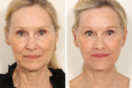 Blepharoplasty case #3567