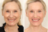 Blepharoplasty case #3567 slider thumbnail