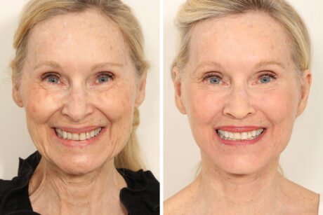 Blepharoplasty case #3567