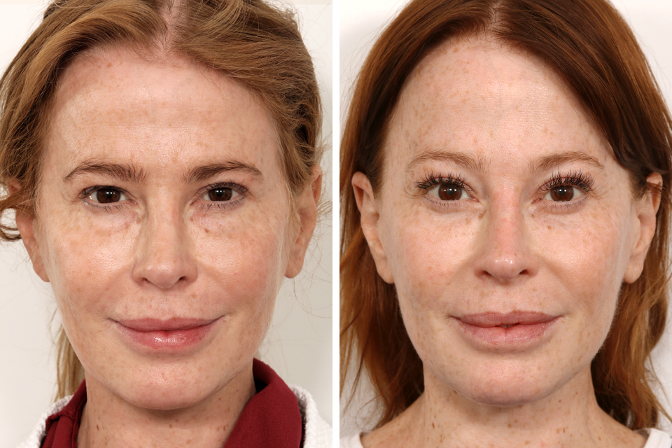 Blepharoplasty case #3540