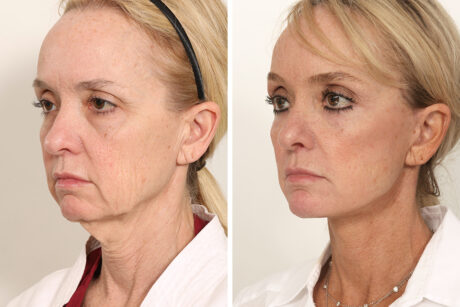 Blepharoplasty case #3555