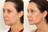 Blepharoplasty case #3578 slider thumbnail