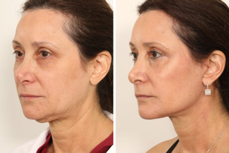 Blepharoplasty case #3578