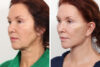 Blepharoplasty case #3563 slider thumbnail