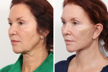 Blepharoplasty case #3563