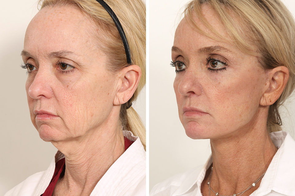 Blepharoplasty case #3555