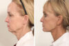 Blepharoplasty case #3555 slider thumbnail